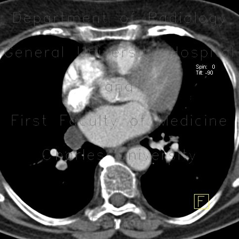 Pericardial cyst