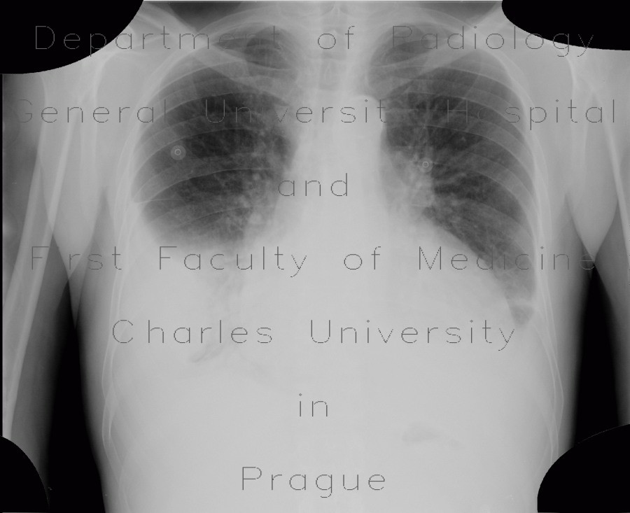 Pericardial effusion after myocardial biopsy, after