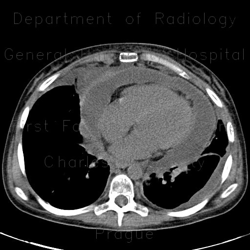 Radiology image - Pericardial effusion, anemia: Thorax, Heart: CT - Computed tomography