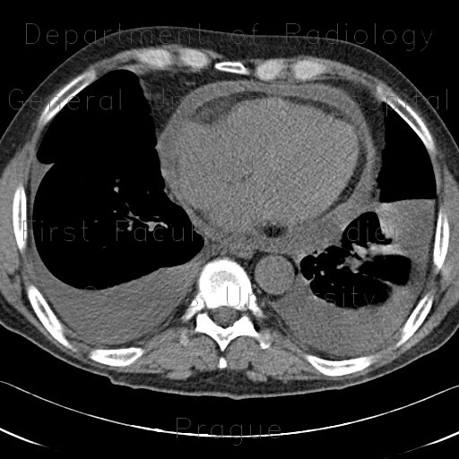 Pericardial effusion, pleural effusion