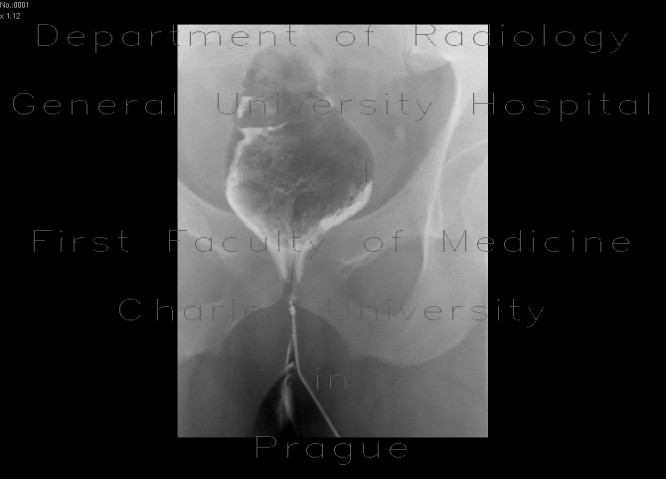 Radiology image - Perineal fistula, communicating with rectum: Abdomen, Large bowel, Retroperitoneum, pelvis: RF - Fluoroscopy