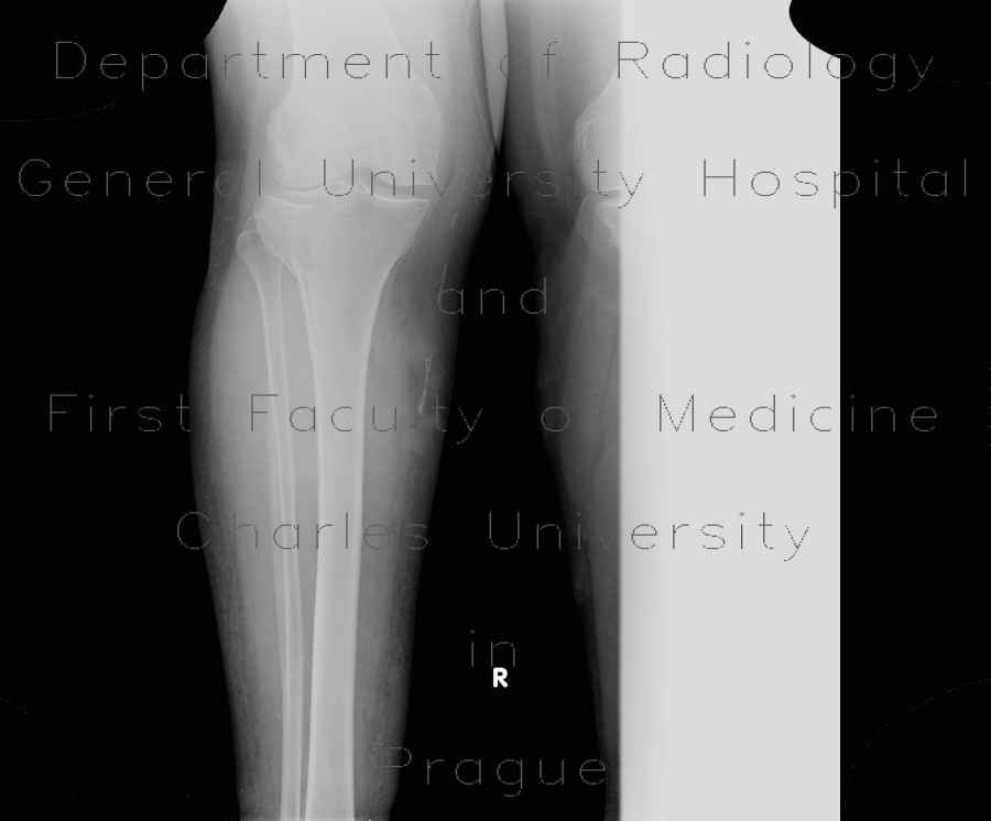 Periostosis, fibula, CVI, chronic venous insufficiency, perimalleolar edema