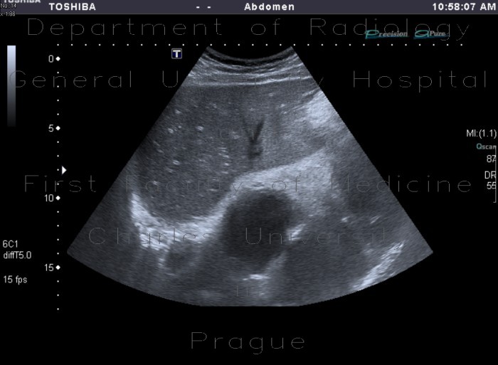 Radiology image - Periportal fibrosis: Abdomen, Liver: US - Ultrasound