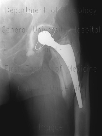 Radiology image - Periprosthetic fracture of the left femur: Extremity, Bone: X-ray - Plain radiograph