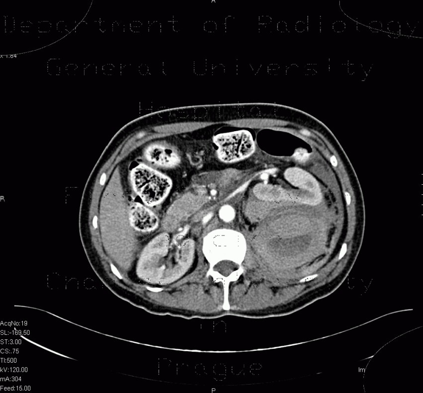 Perirenal hematoma after biopsy