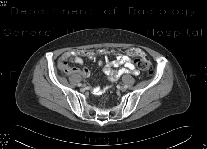 Peritoneal carcinosis