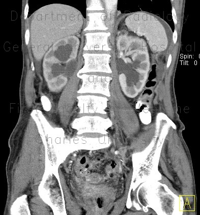 Peritoneal carcinosis, hydronephrosis