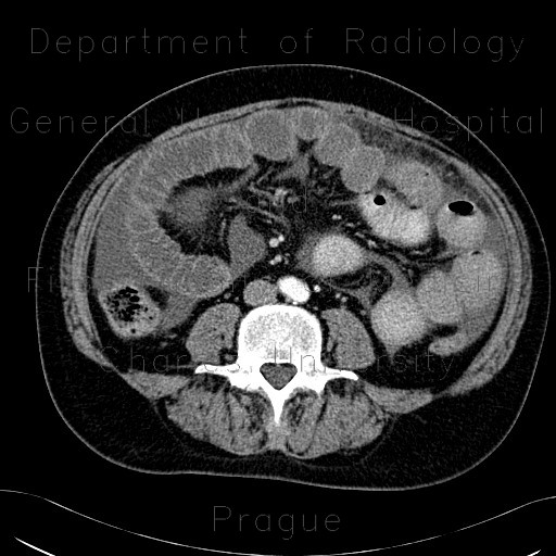 Radiology image - Peritoneal dialysis, complication, fluid collection, gigantic, before: Abdomen, Peritoneal cavity: CT - Computed tomography