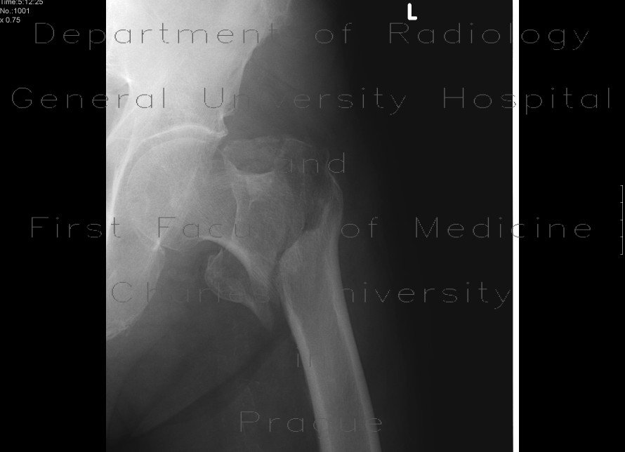 Radiology image - Pertrochanteric fracture, comminuted: Extremity, Bone: X-ray - Plain radiograph