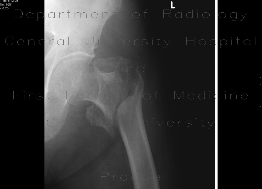 Pertrochanteric fracture, comminuted