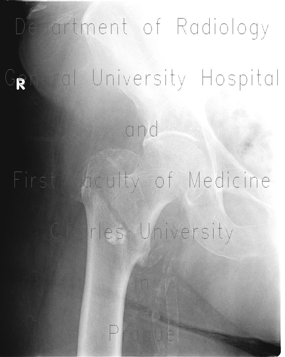Radiology image - Pertrochanteric fracture, hardware migration, non-union: Extremity, Bone: X-ray - Plain radiograph