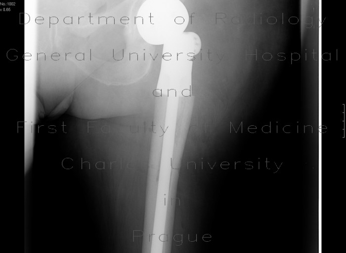 Pertrochanteric fracture of femur, osteosynthesis, refracture, total endoprosthesis