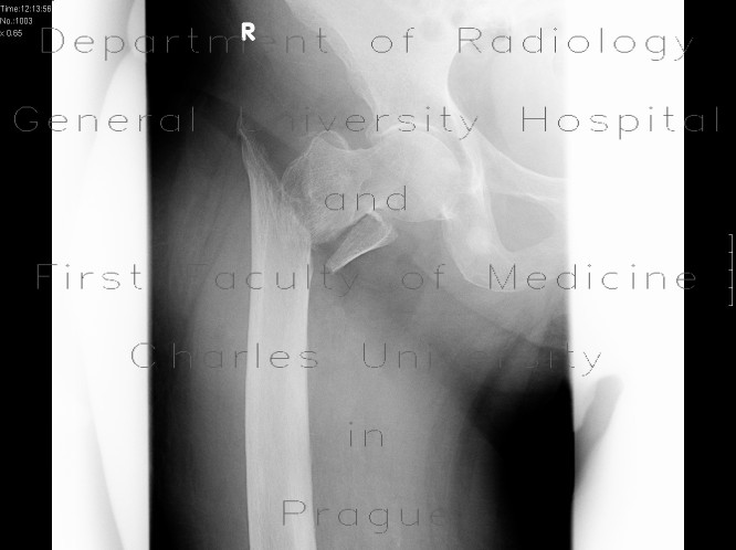 Pertrochanteric fracture of the femur