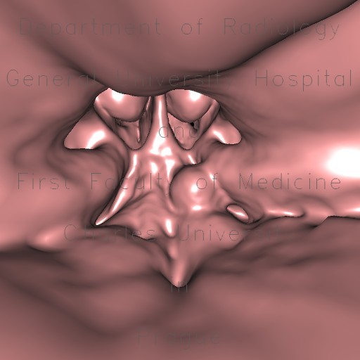 Pharyngeal tonsil, enlargement, virtual endoscopy