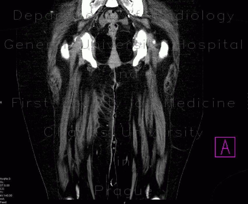 Radiology image - Phegmon of thigh: Extremity, Soft tissue: CT - Computed tomography