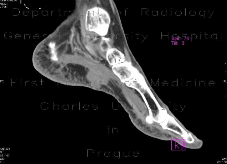 Radiology image - Plantar lymphoma: Extremity, Lymphatic: CT - Computed tomography