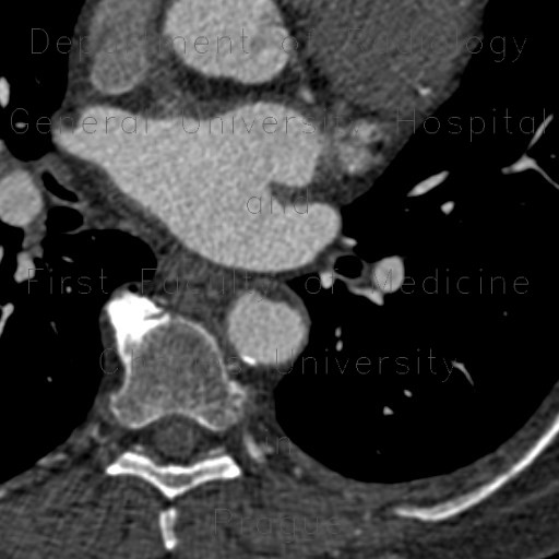 Radiology image - Plaques in the thoracic aorta, lipid: Thorax, Vessels: CT - Computed tomography