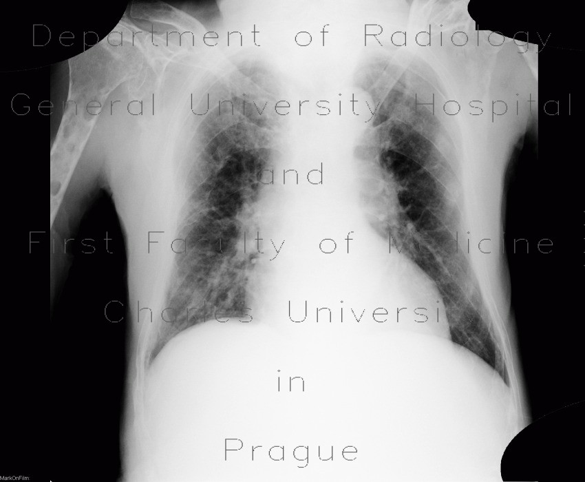 Radiology image - Plasmocytoma: Thorax, Bone: X-ray - Plain radiograph