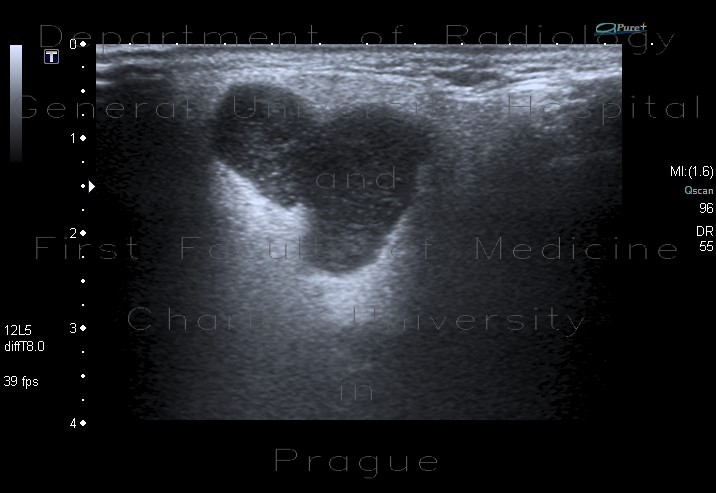 Pleomorphic adenoma, parotid gland