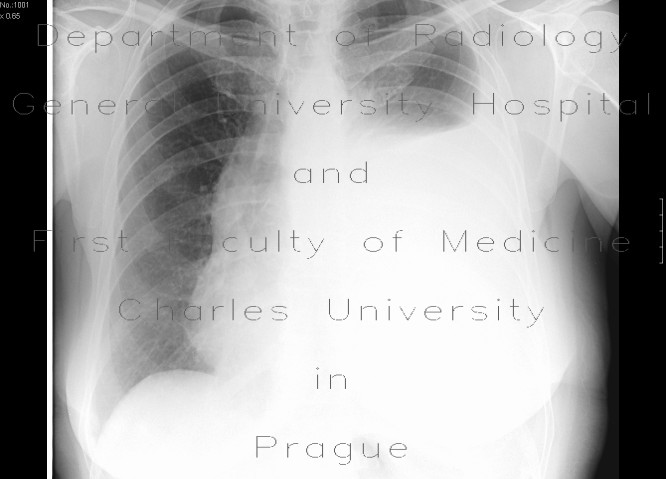 Pleural effusion