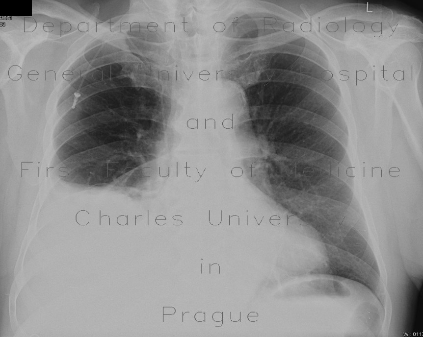 Pleural effusion