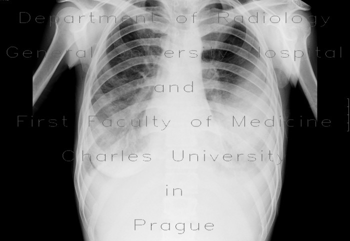 Radiology image - Pleural effusion, loculated: Thorax, Mediastinum and pleural cavity: X-ray - Plain radiograph