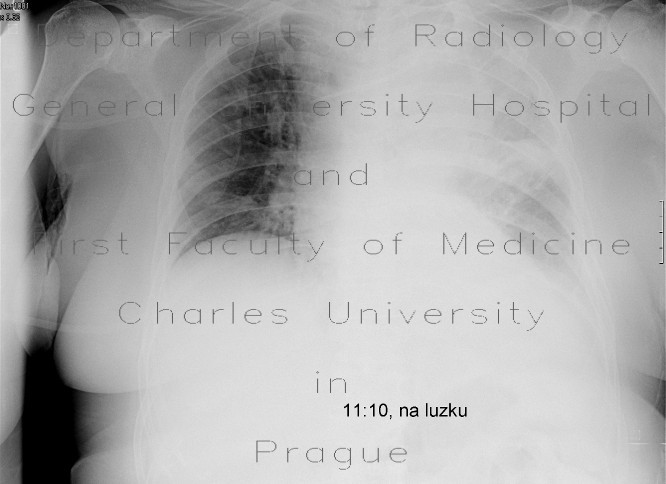 Pleural effusion, lung tumour