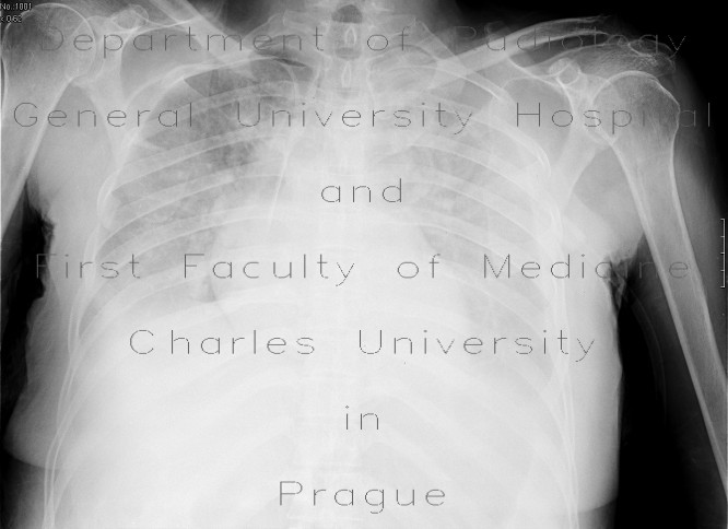 Pleural effusion, supine radiograph, before and after evacuation
