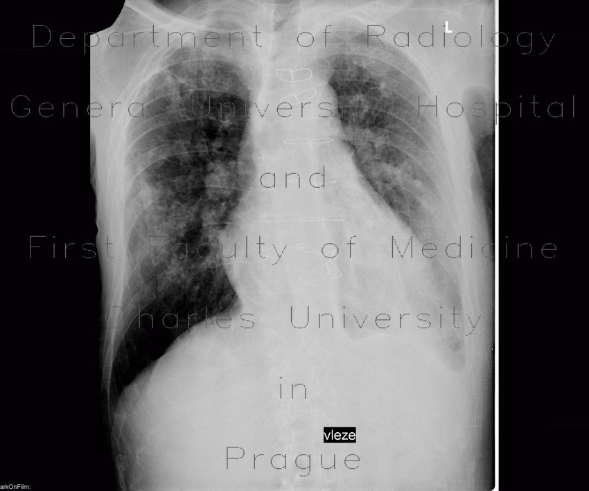 Pleural plaques, pachypleuritis