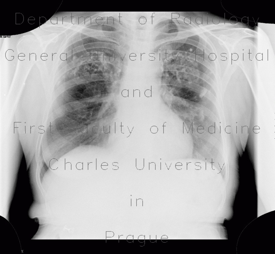 Radiology image - Pleuritis calcarea, calcifications, pachypleuritis: Thorax, Lung, Mediastinum and pleural cavity: X-ray - Plain radiograph
