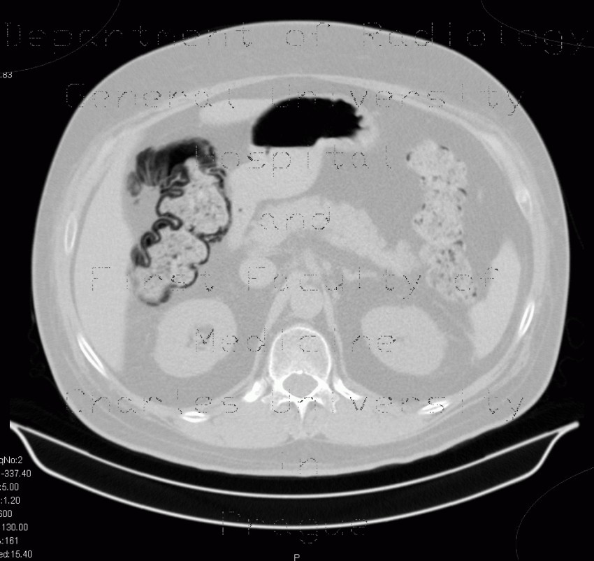 Radiology image - Pneumatosis intestinalis: Abdomen, Large bowel: CT - Computed tomography