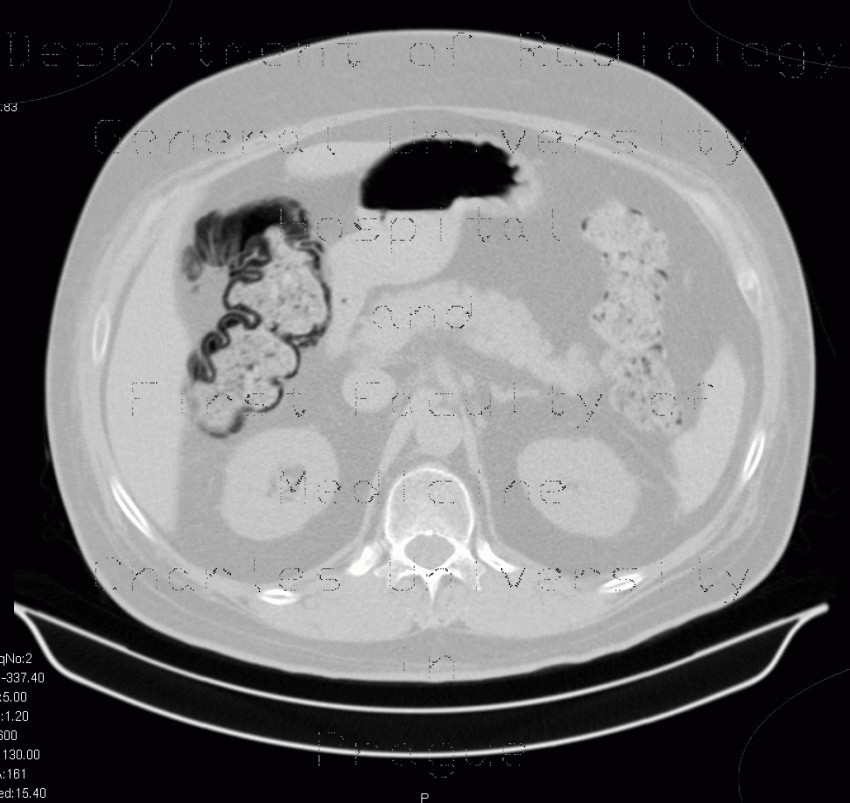 Pneumatosis intestinalis