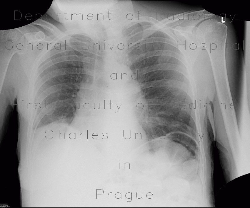 Pneumatosis of lienal flexure, constipation, skyballa