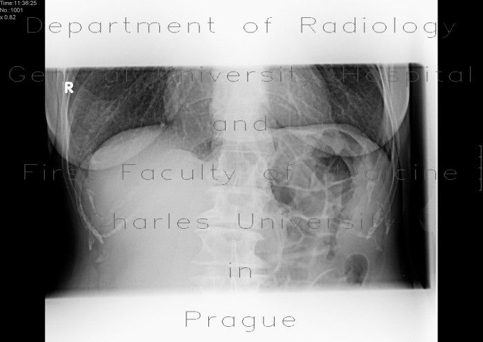 Radiology image - Pneumatosis of small bowel, meteorism: Abdomen, Small bowel: X-ray - Plain radiograph
