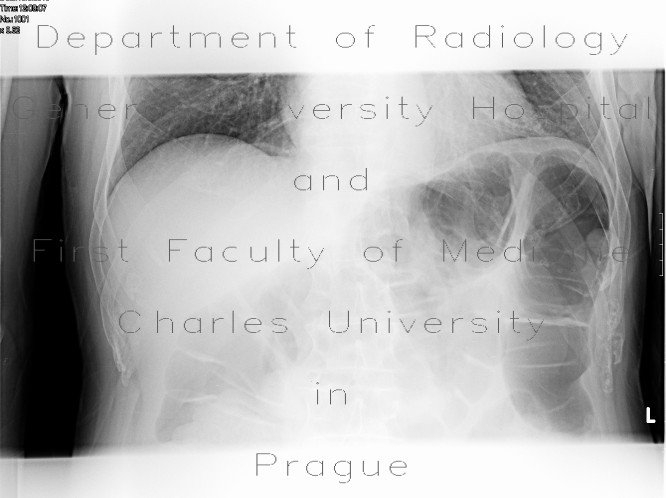 Pneumatosis of the colon