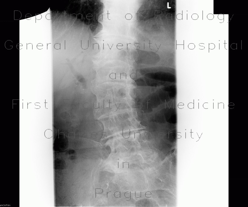 Radiology image - Pneumobilia: Abdomen, Spine and Axial, Biliary tree, Bone: X-ray - Plain radiograph