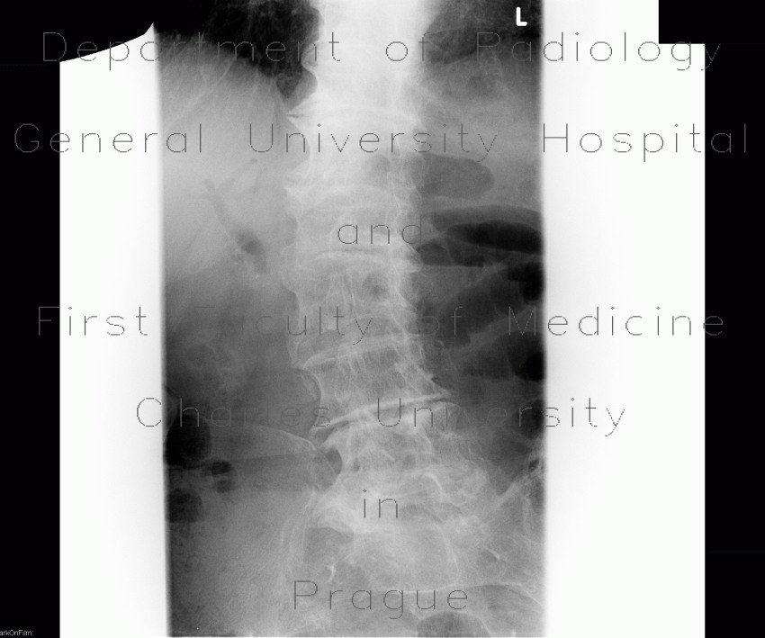 Pneumobilia
