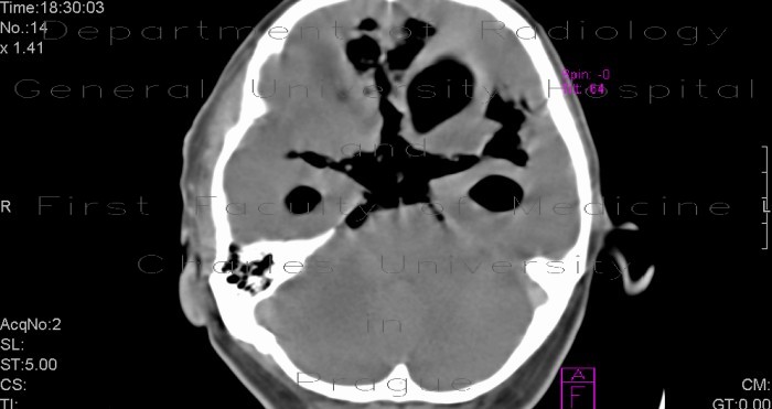 Radiology image - Pneumocephalus, massive: Brain, Brain: CT - Computed tomography