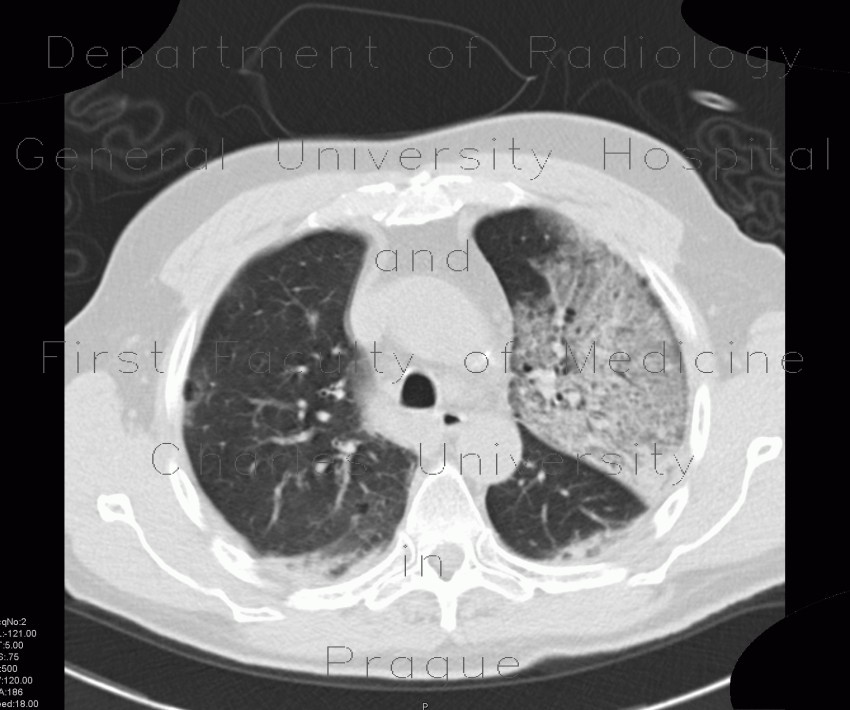 Pneumocystic pneumonia, atypical pneumonia