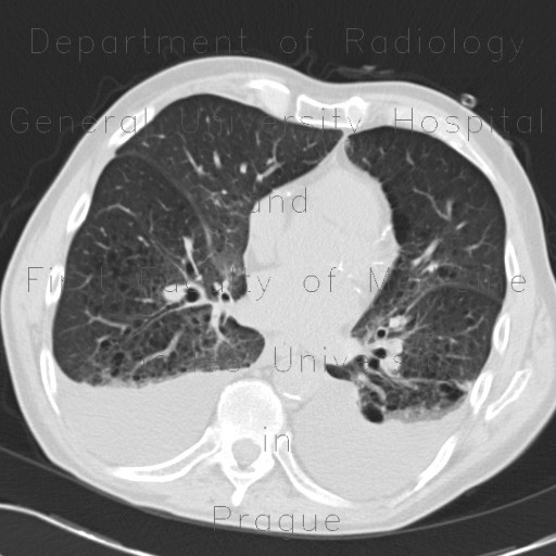 Radiology image - Pneumocystis carinii, pneumocystic pneumonia, HRCT: Thorax, Lung, Mediastinum and pleural cavity: CT - Computed tomography
