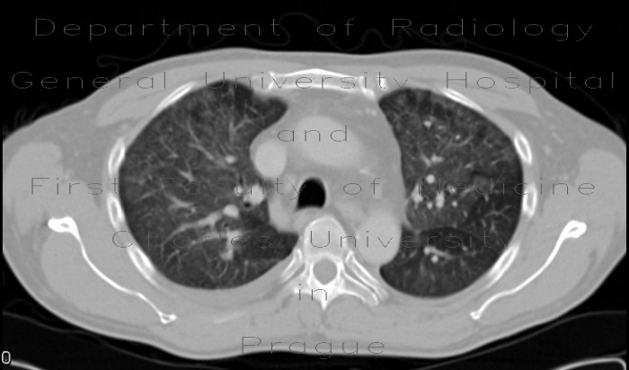 Radiology image - Pneumocystis pneumonia: Thorax, Lung: CT - Computed tomography