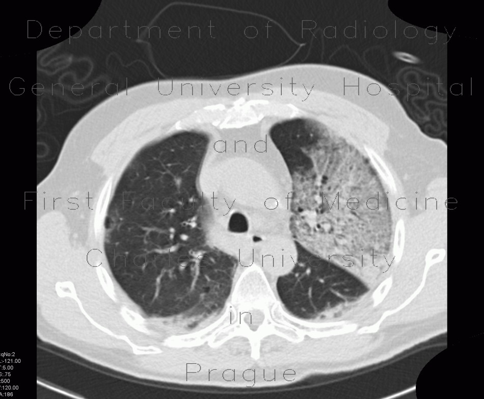 Radiology image - Pneumocystis pneumonia, PCP, Pneumocystis carinii: Thorax, Lung: CT - Computed tomography