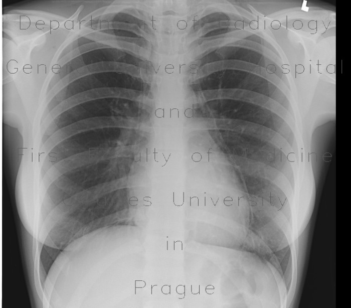 Pneumomediastinum