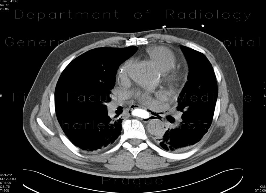 Radiology image - Pneumomediastinum: Thorax, Mediastinum and pleural cavity: CT - Computed tomography