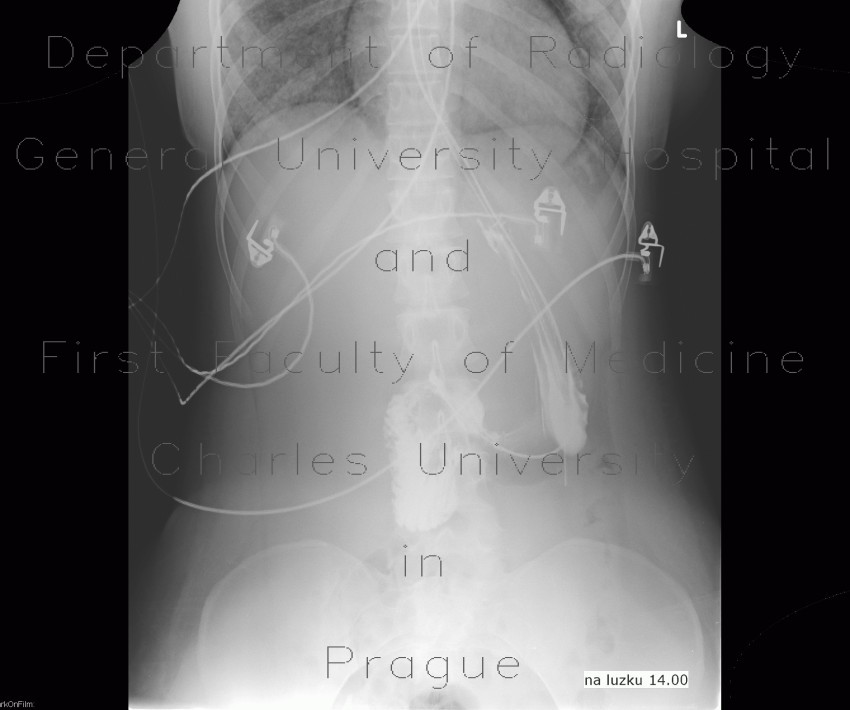 Pneumomediastinum, pneumocolum, subcutaneous emphysema, intermuscular emphysema