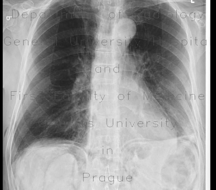 Pneumomediastinum, pneumoretroperitoneum, perforation of sigmoid colon, complication of colonoscopy