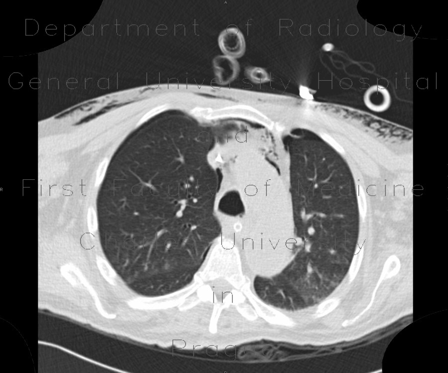 Pneumomediastinum, pneumothorax, PNO, subcutaneous emphysema