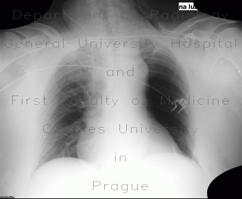 Pneumonectomy