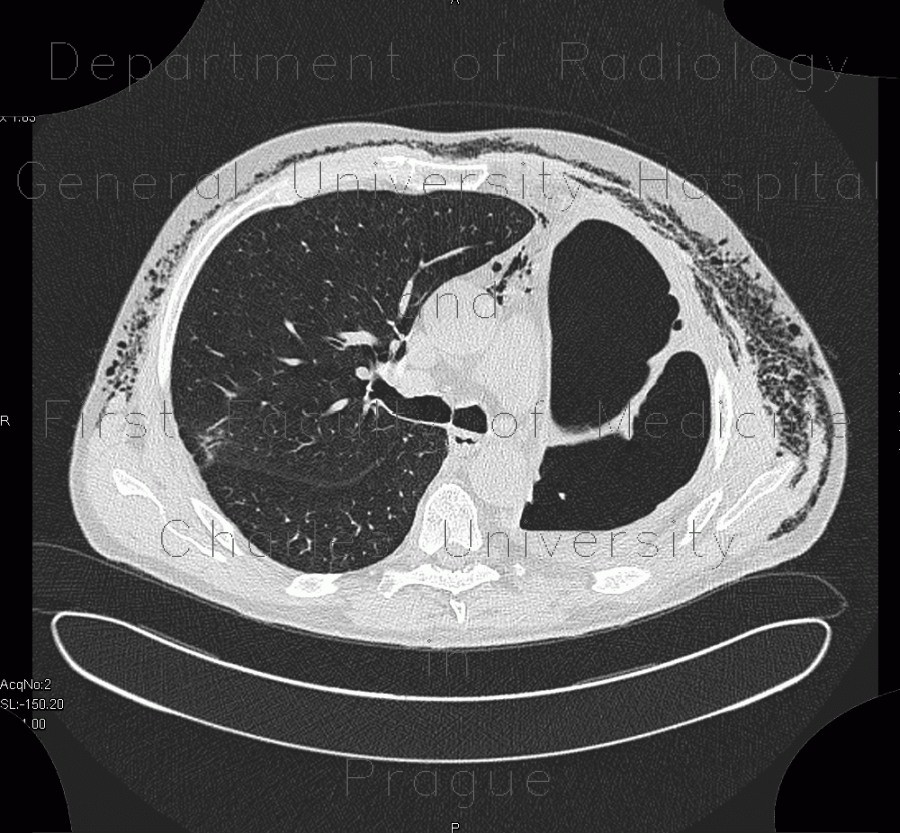 Radiology image - Pneumonectomy, hematoma of the pleural cavity, subcutaneous emphysema: Thorax, Lung, Mediastinum and pleural cavity: CT - Computed tomography