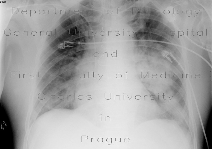Radiology image - Pneumonia: Thorax, Lung: X-ray - Plain radiograph